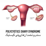 polycystic ovary syndrome