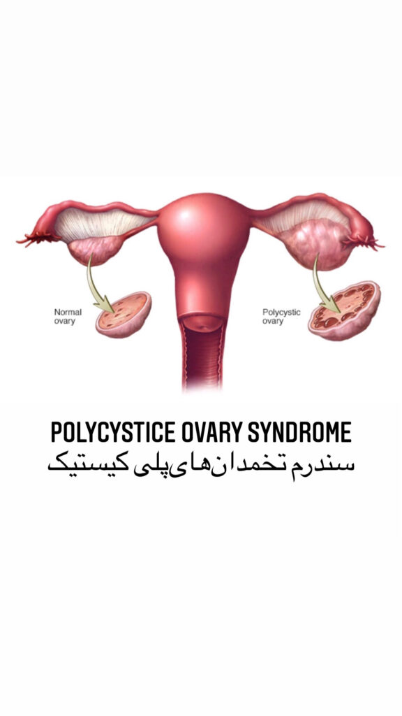 polycystic ovary syndrome