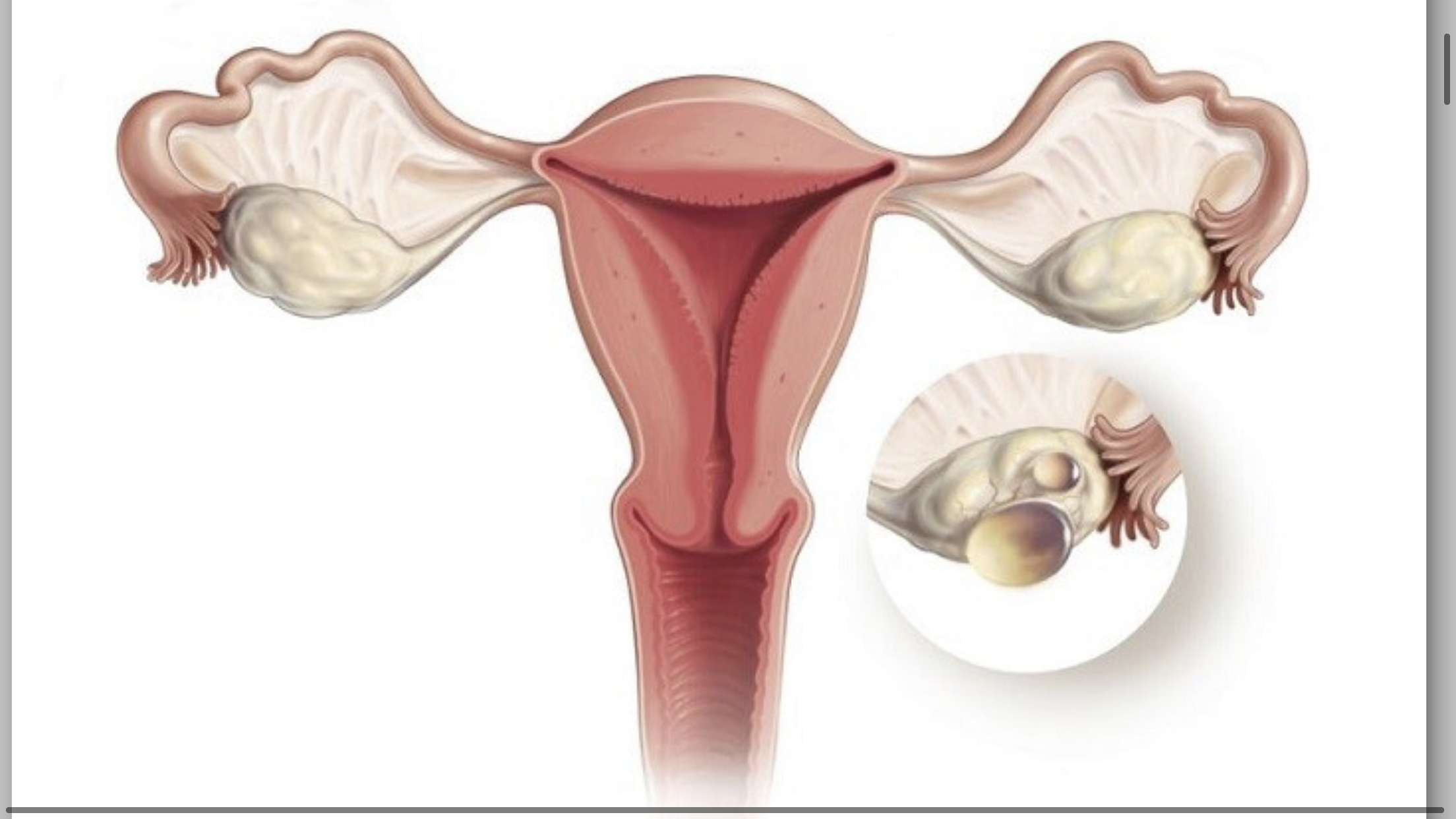 تعریف pcos